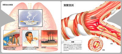 型抜き絵本 喘息と慢性閉塞性肺疾患（COPD） 05-06ページ