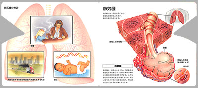 型抜き絵本 喘息と慢性閉塞性肺疾患（COPD） 07-08ページ