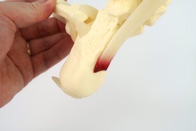 足底筋膜炎