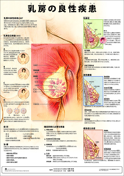 人体解剖図（人体図）　ミニポスター　乳房の良性疾患