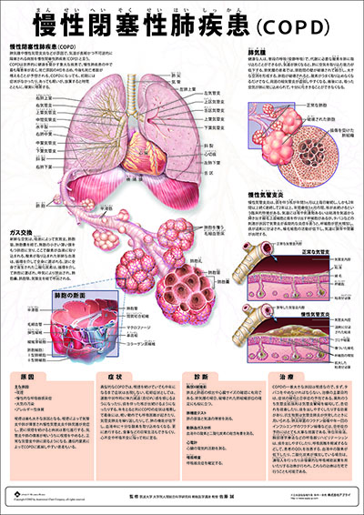 人体解剖図（人体図）　ミニポスター　慢性閉塞性肺疾患（COPD)