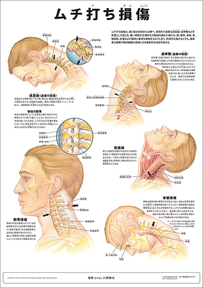人体解剖図（人体図）　ミニポスター　ムチ打ち損傷
