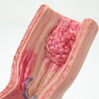 食道がん・逆流性食道炎