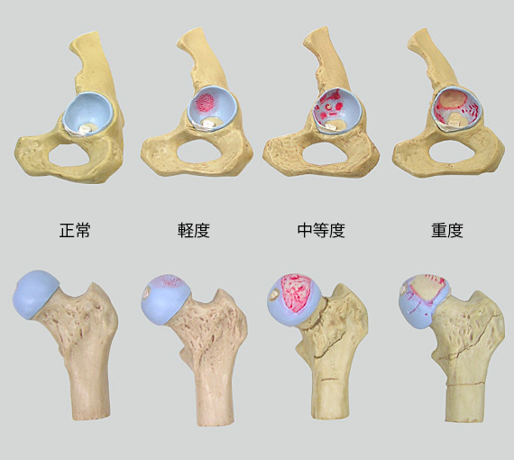 4段階の股関節模型セット全体像