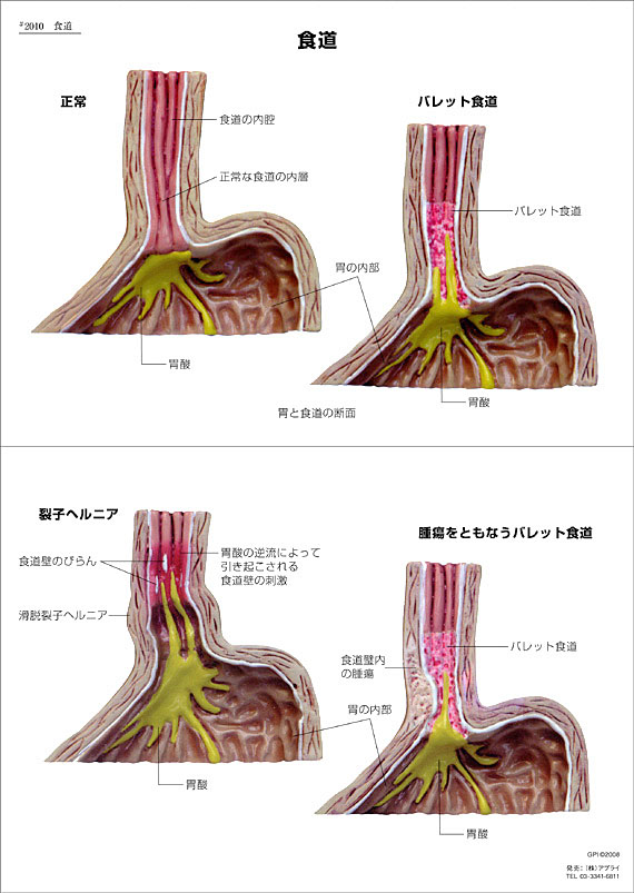 逆流性食道炎模型に付属する英文イラストカード