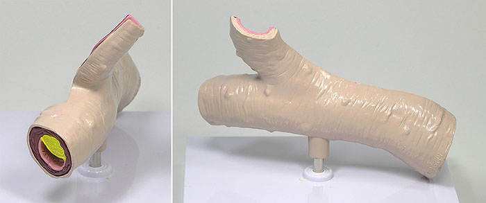 動脈硬化が進行し内腔が狭窄していく様子