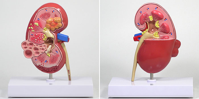 腎臓疾患モデルの全体像(疾患面)。結石や腫瘍などが確認できる。