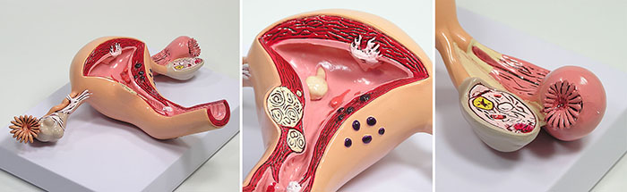 子宮・卵巣の諸疾患を示す模型の全体像。子宮筋腫や卵管炎などが確認できる。