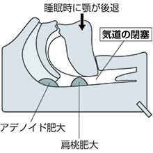 睡眠時無呼吸症候群（OSAS）模型　詳細画像03