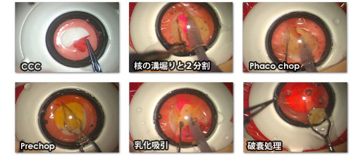 白内障手術練習用模擬眼 机太郎ウェットラボセット 詳細画像6