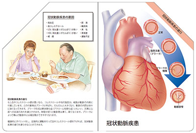 型抜き絵本 冠状動脈疾患 03-04ページ