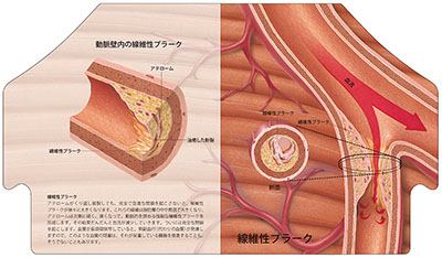 型抜き絵本 アテローム性動脈硬化 09-10ページ