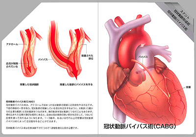 型抜き絵本 冠状動脈の血行再建術 05-06ページ