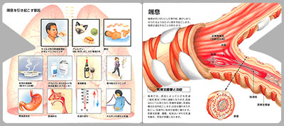 型抜き絵本 喘息と慢性閉塞性肺疾患（COPD） 03-04ページ