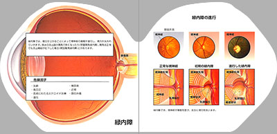 型抜き絵本 緑内障の知識 03-04ページ