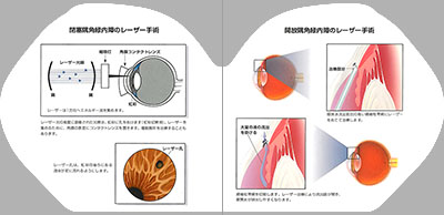 型抜き絵本 緑内障の知識 09-10ページ