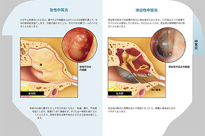 型抜き絵本 中耳炎 05-06ページ