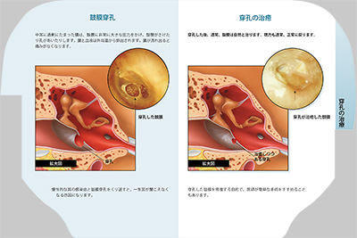 型抜き絵本 中耳炎 07-08ページ