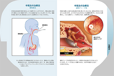 型抜き絵本 中耳炎 09-10ページ