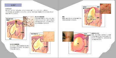 型抜き絵本 皮膚の病気 03-04ページ