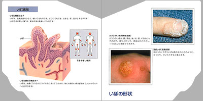 型抜き絵本 皮膚の病気 05-06ページ
