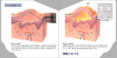 型抜き絵本 皮膚の病気 07-08ページ