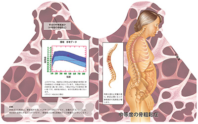 型抜き絵本 骨粗鬆症 05-06ページ