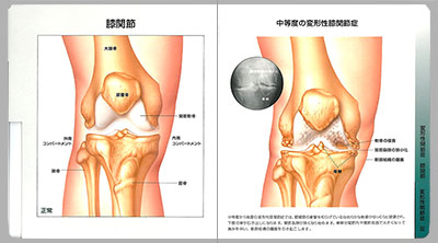 型抜き絵本 変形性関節症（OA） 05-06ページ