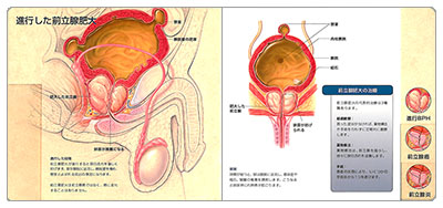 型抜き絵本 前立腺 05-06ページ