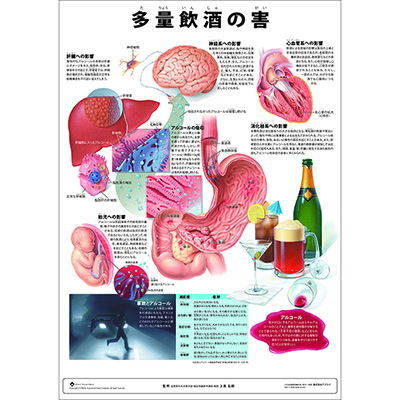 （医学ポスター）　ミニポスター　多量飲酒の害