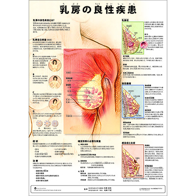 （医学ポスター）　ミニポスター　乳房の良性疾患