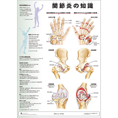 （医学ポスター）　ミニポスター　関節炎の知識