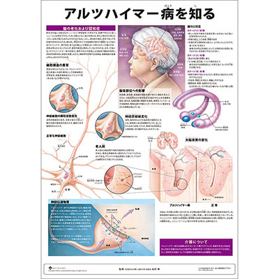 （医学ポスター）　ミニポスター　アルツハイマー病を知る
