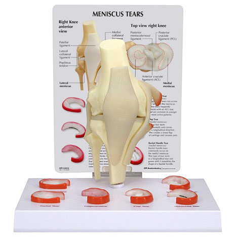 人体模型　半月板損傷　GPI Anatomicals
