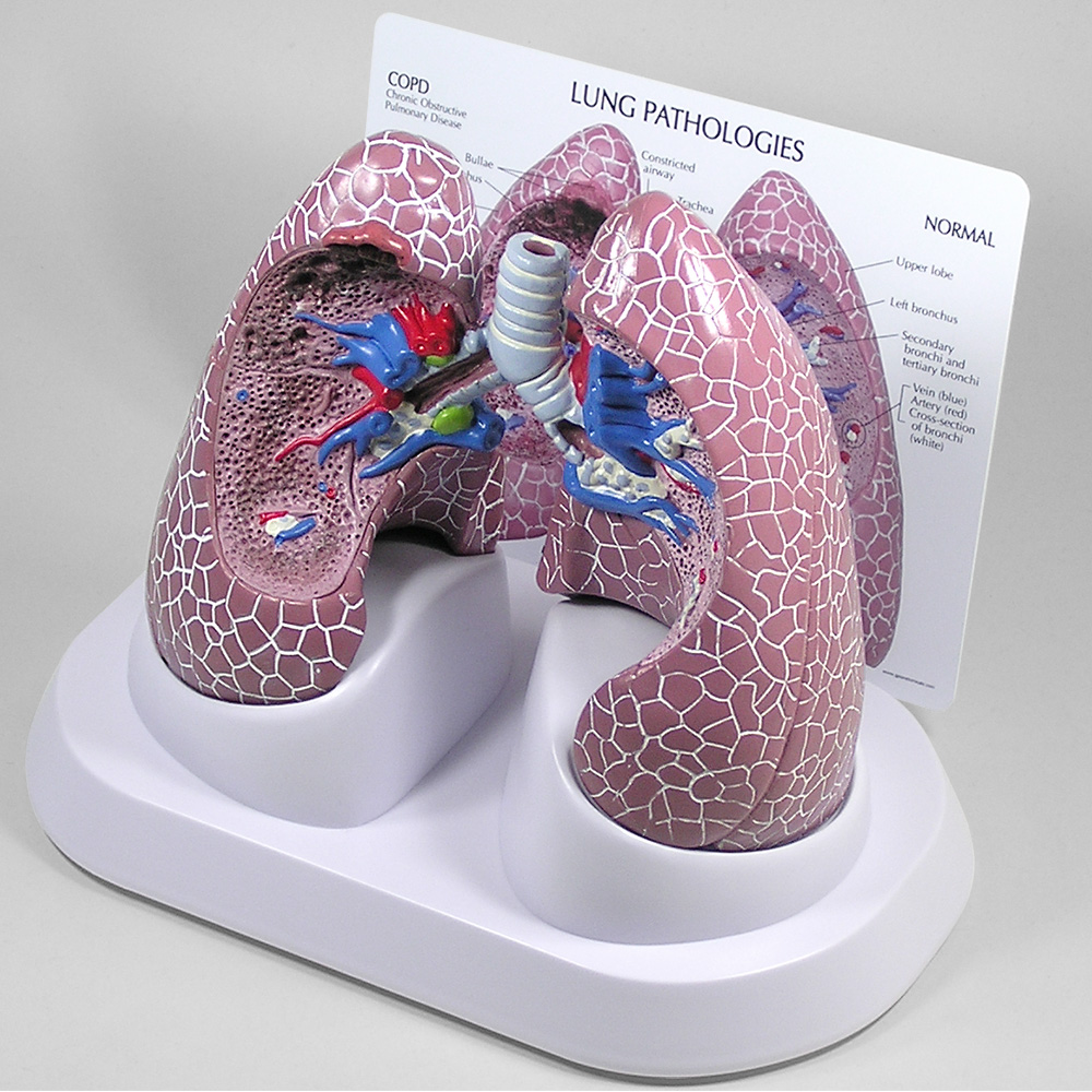 医学模型　肺の主要疾患　GPI Anatomicals
