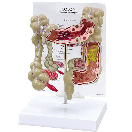 医学模型　大腸諸疾患　GPI Anatomicals