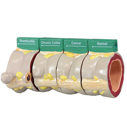 医学模型　大腸諸疾患4個　GPI Anatomicals
