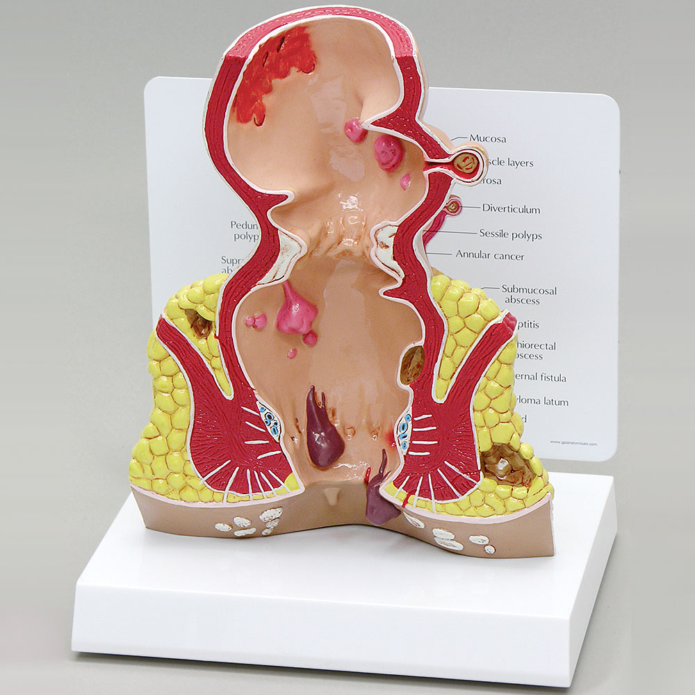 医学模型　直腸諸疾患　GPI Anatomicals