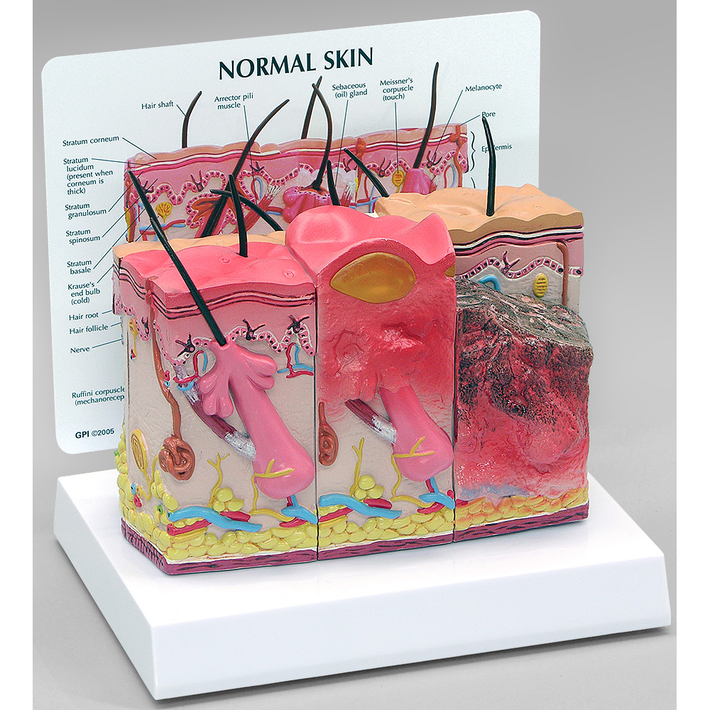 医学模型　皮膚/正常とやけど　GPI Anatomicals