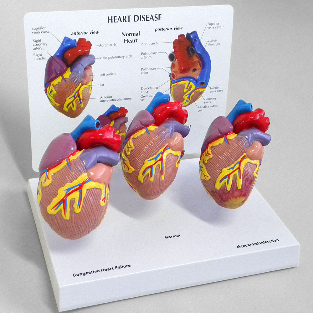 人体模型　心臓疾患　GPI Anatomicals