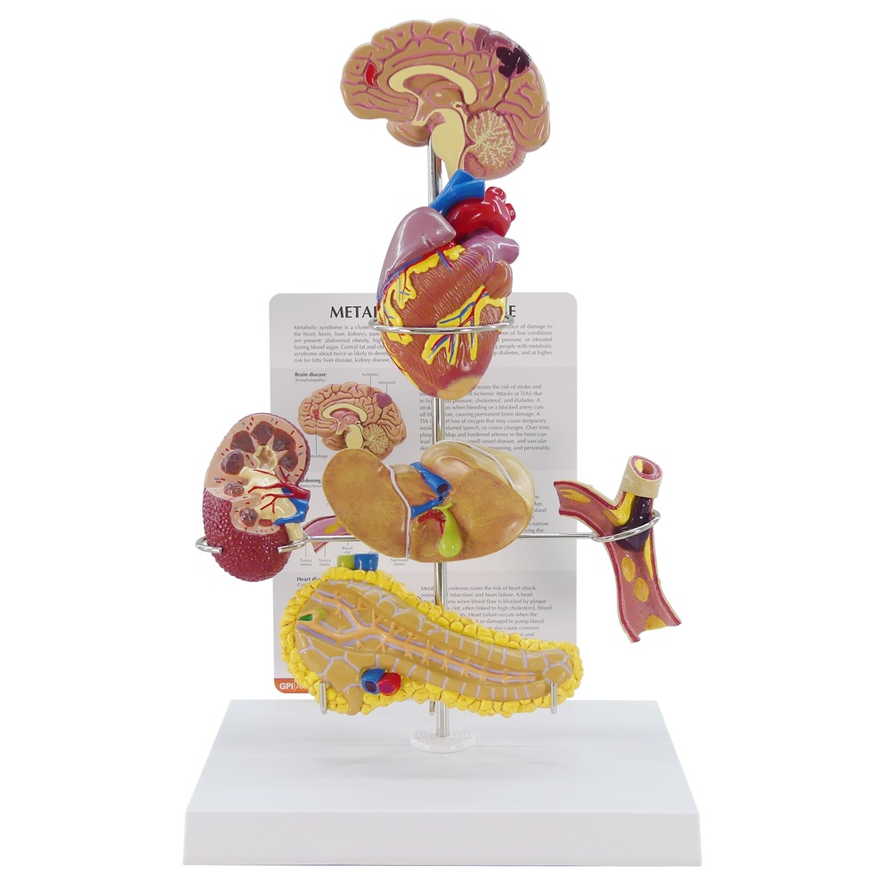 医学模型　メタボリックシンドロームの影響　GPI Anatomicals