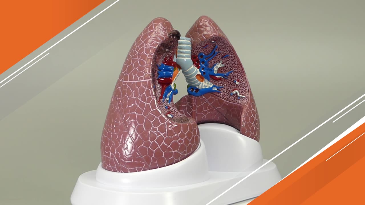 医学模型 肺の主要疾患 GPI Anatomicals | 人体百科