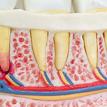 人体模型　歯と歯茎の疾患　詳細画像