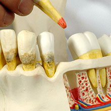 人体模型　歯と歯茎の疾患　詳細画像