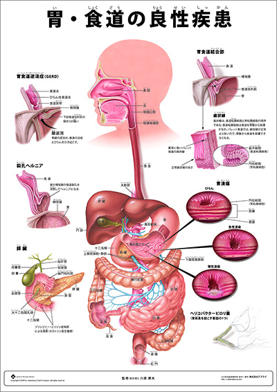 人体解剖図（人体図）　ミニポスター　胃・食道の良性疾患