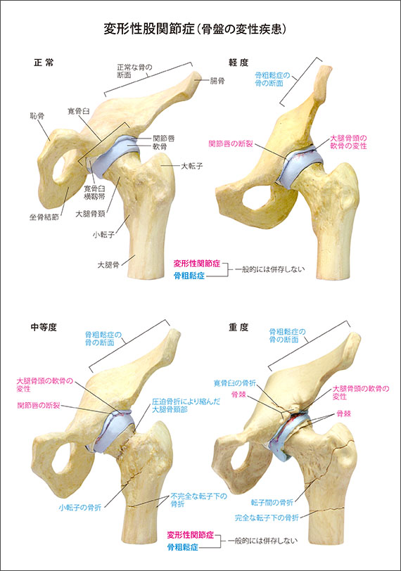 医学模型 変形性関節症/4段階 日本語解説書