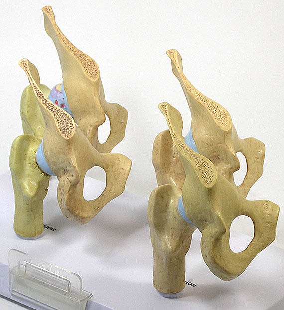 医学模型　変形性関節症/4段階　骨盤断面画像