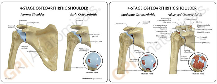 医学模型　変形性肩関節症/4段階　カード画像