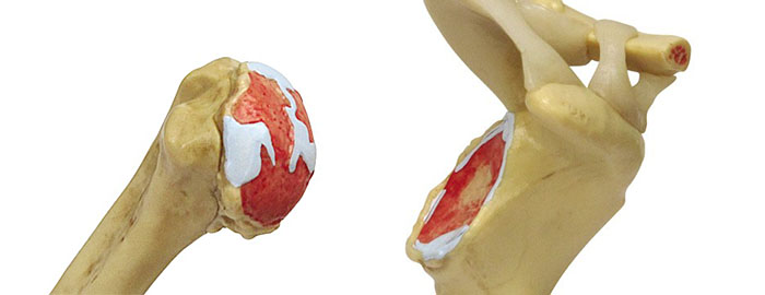 医学模型　変形性肩関節症/4段階　詳細画像