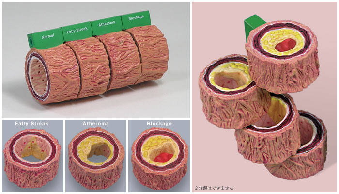 医学模型 動脈硬化4個 詳細画像